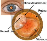 detached retina